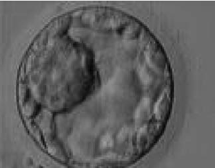 Blastocyst Embryo Transfer